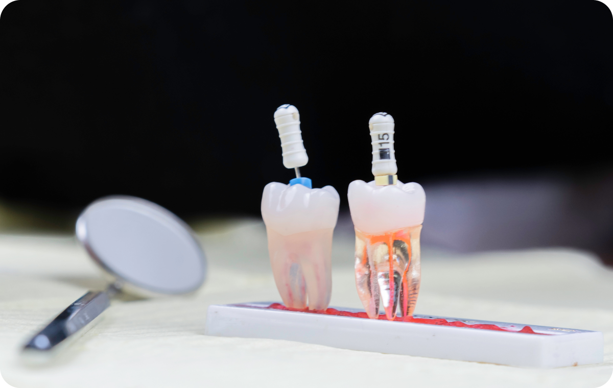 greffe osseuse mesnils sur iton Endodontie