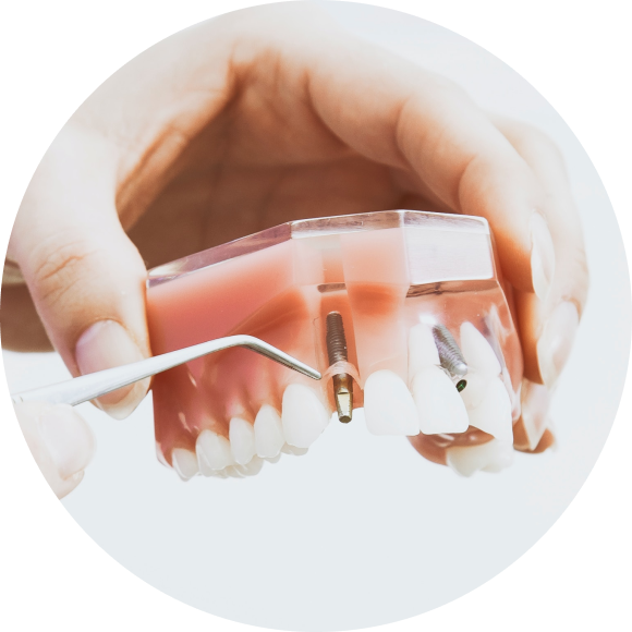 implant cabinet dentaire rosalba mesnil sur iton implant cabinet dentaire rosalba mesnil sur iton Soins des prothèses amovibles