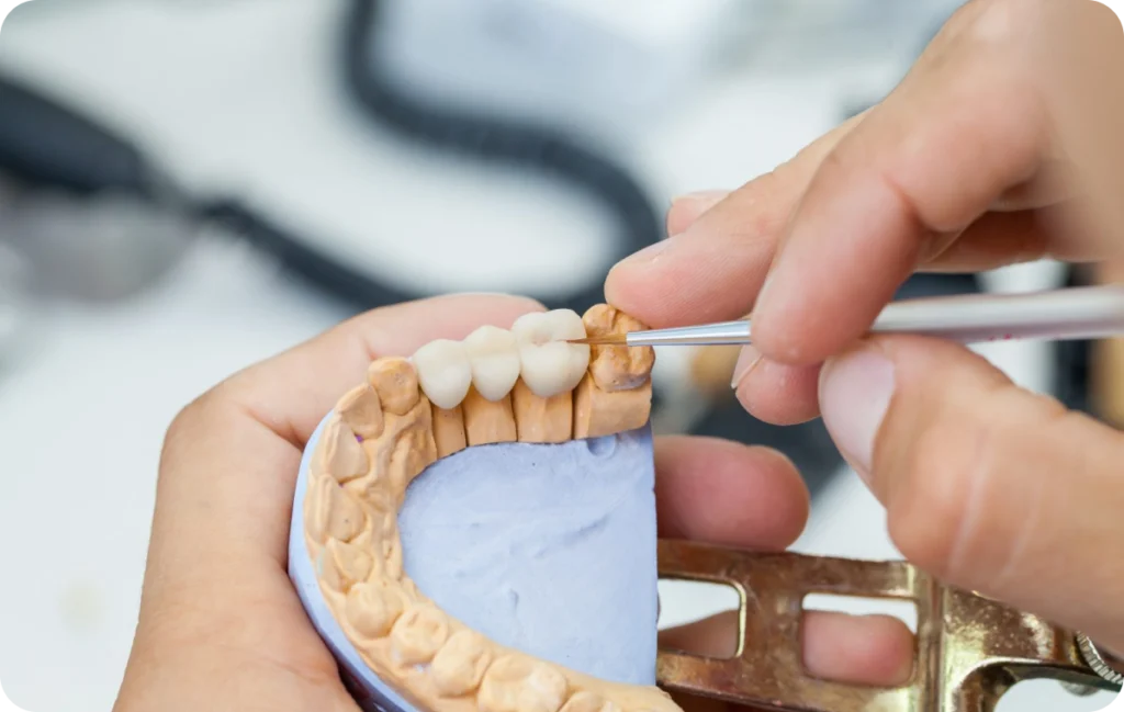 prothese fixe mesnils sur iton Prothèse fixe