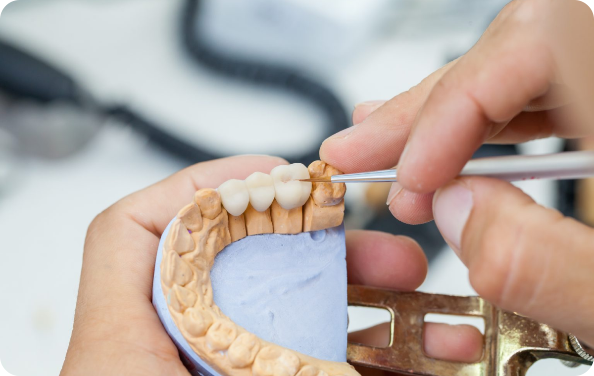 prothese fixe mesnils sur iton Prothèse fixe