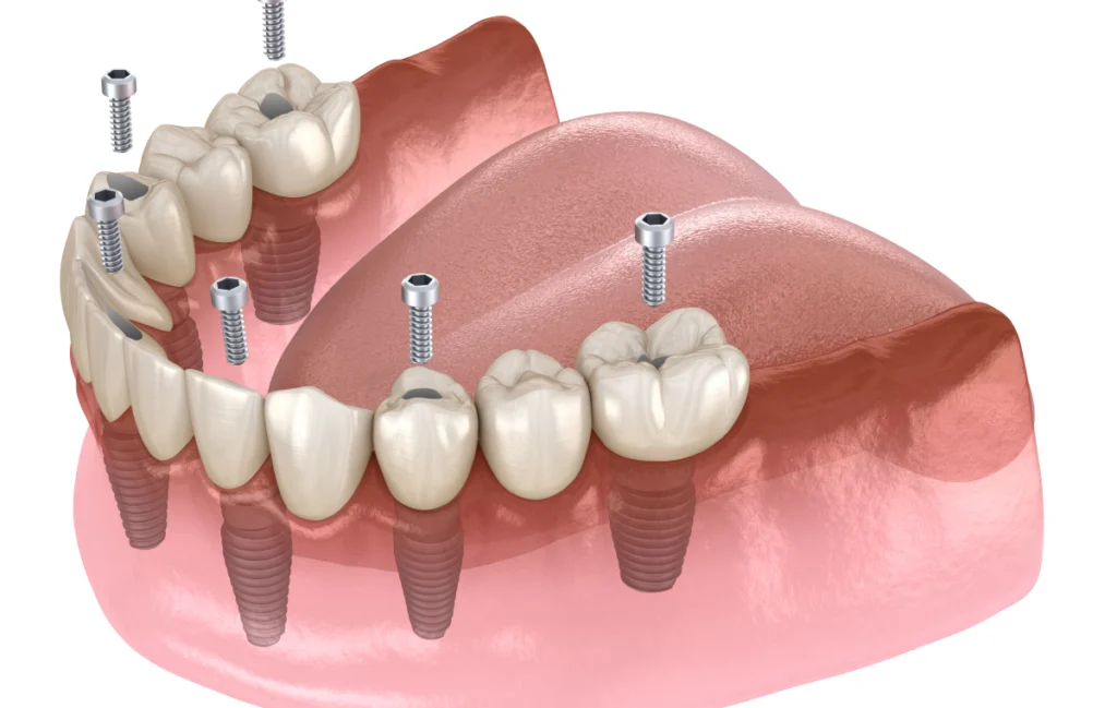 protheses dentaires fixes mesnils sur iton Prothèse fixe