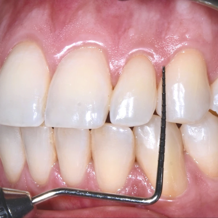 parodontie mesnils sur iton