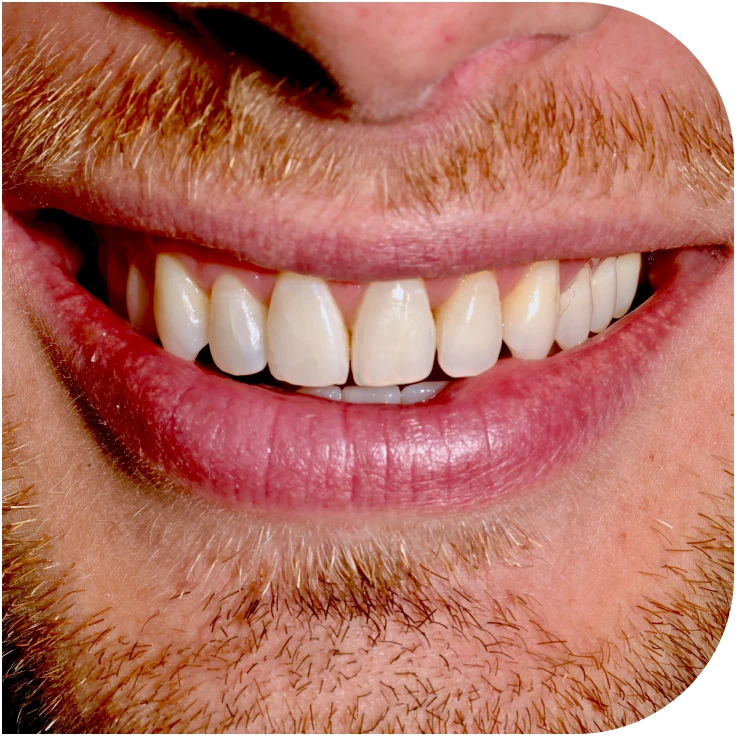 protheses dentaires mesnils sur iton